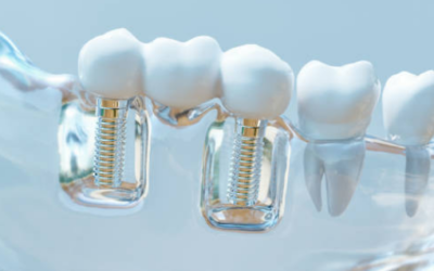 Implanty stomatologiczne – zalety i rodzaje