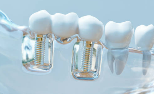 Implanty stomatologiczne Wrocław