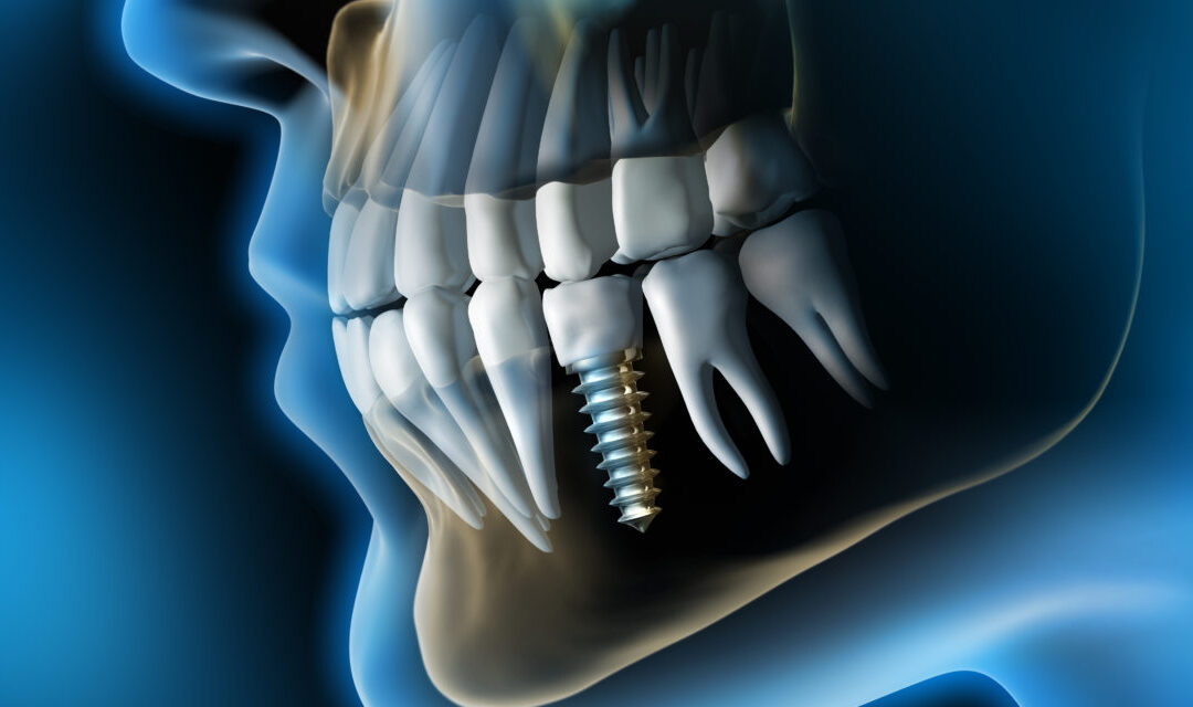 Implanty Wrocław - profesjonalne implanty zębowe