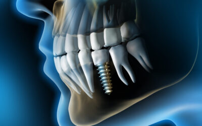 Implanty Wrocław: Przewodnik po Chirurgicznej Odnowie Uśmiechu