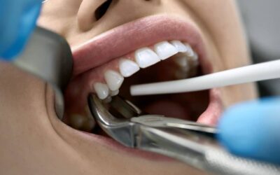 Usuwanie zęba – kiedy i dlaczego stomatolog może usunąć chory ząb?